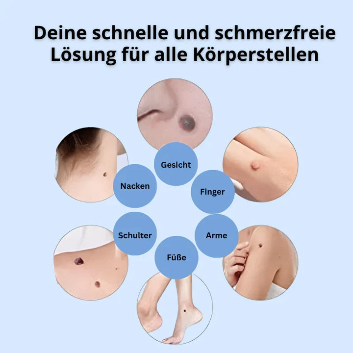 Dermalux® | Never Again Skin Tags