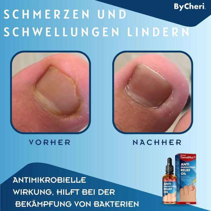 1+1 FREE TEMPORARILY ToePerfect Heal Toe and Finger Nails, view 3 - Elena Harper