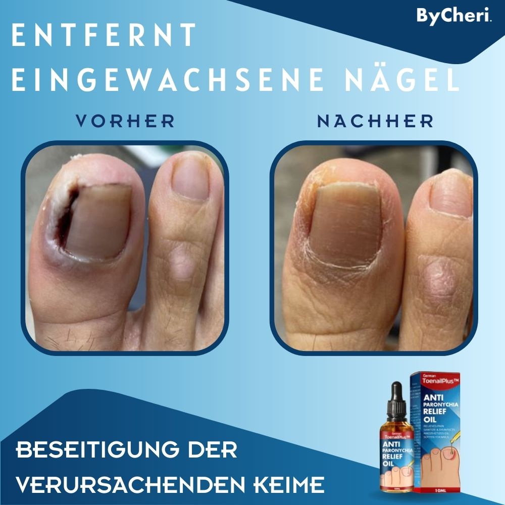 1+1 FREE TEMPORARILY ToePerfect Heal Toe and Finger Nails, view 4 - Elena Harper