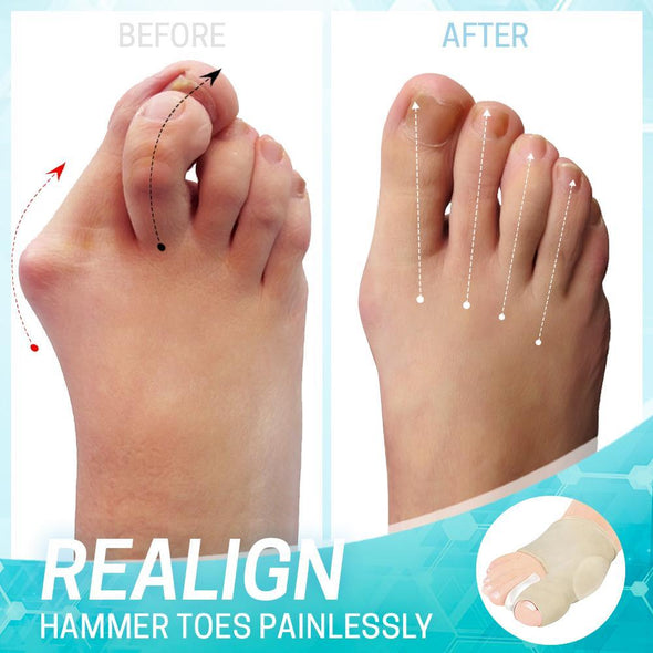 Bunion Correction Sleeve