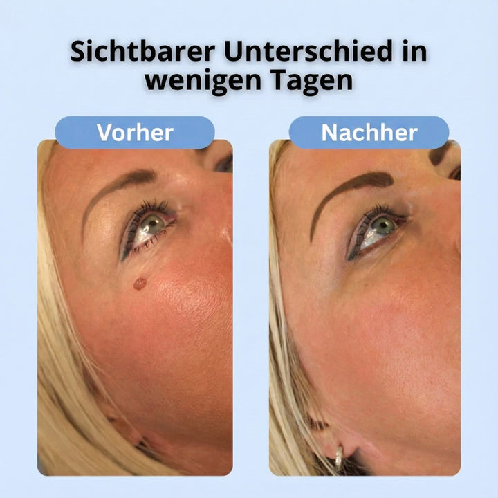 Dermalux® | Never Again Skin Tags