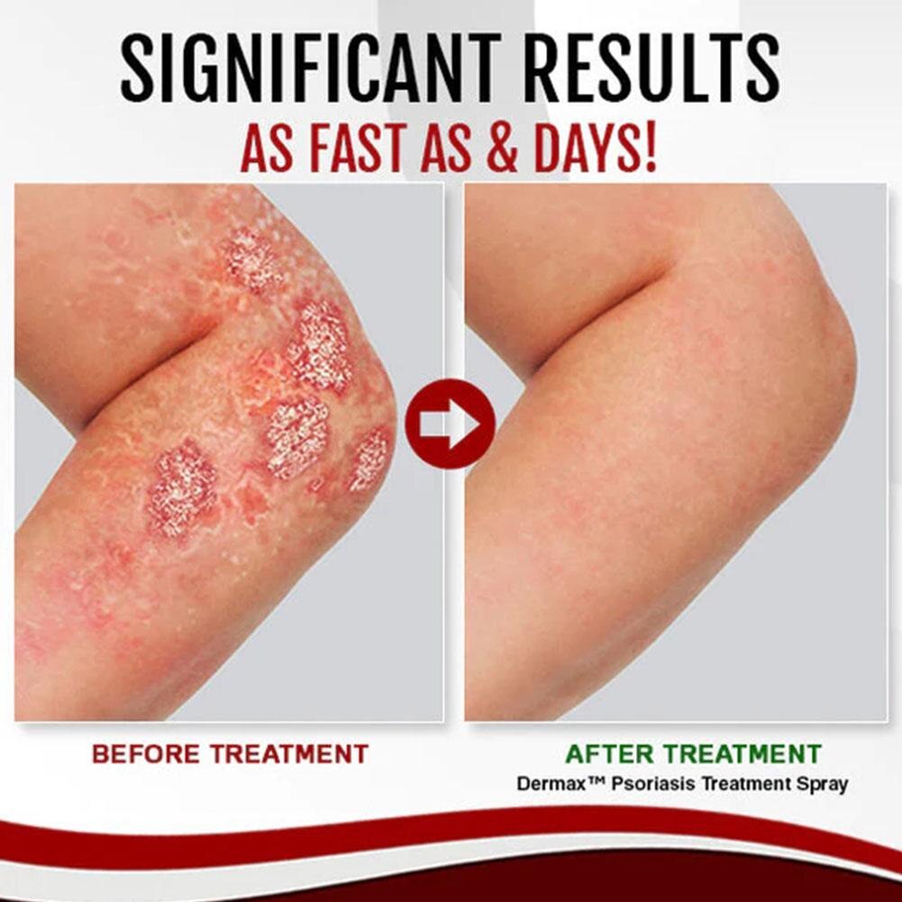 Dermax™ Psoriasis Spray