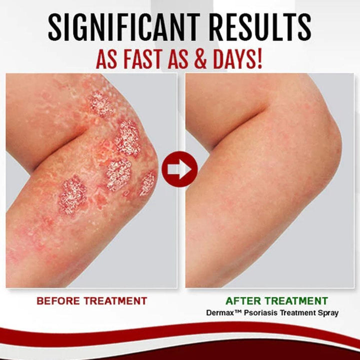 Dermax™ Psoriasis Spray