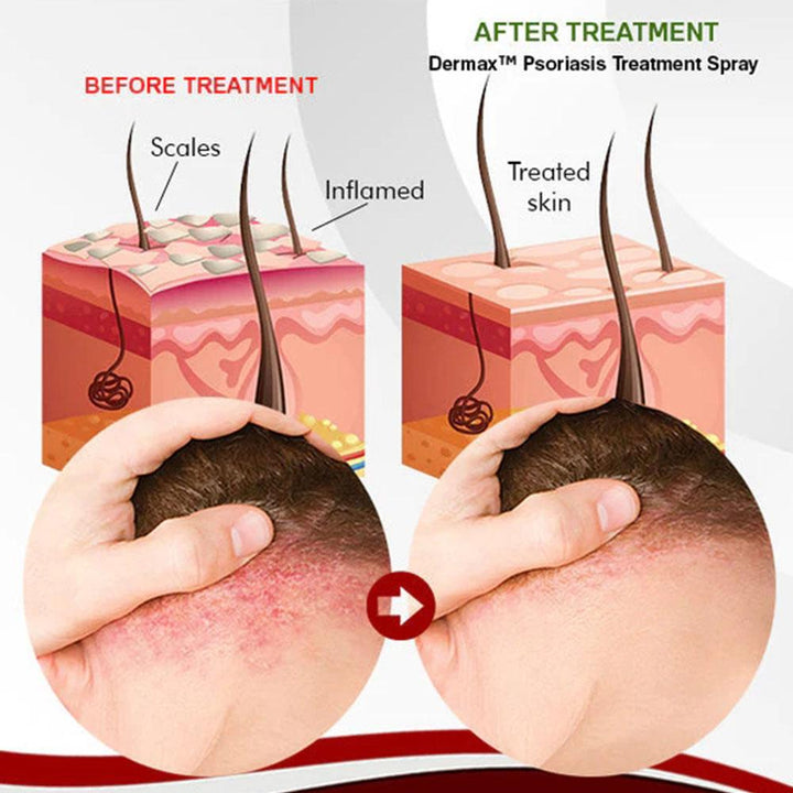 Dermax™ Psoriasis Spray